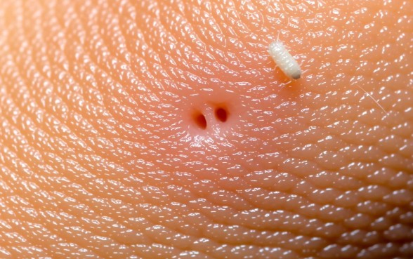 什么虫子白色的咬一下有两个口子，被虫子咬了怎么办