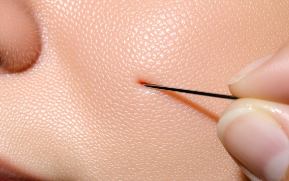 五毫米的口子要缝针吗，伤口缝针视频教程下载