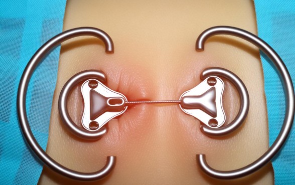 下钢板的口子一般多久不要包纱布，拆线后纱布还要包几天